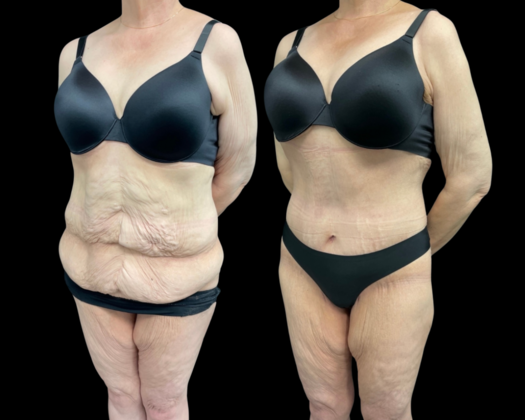 Lower Body Lift Case