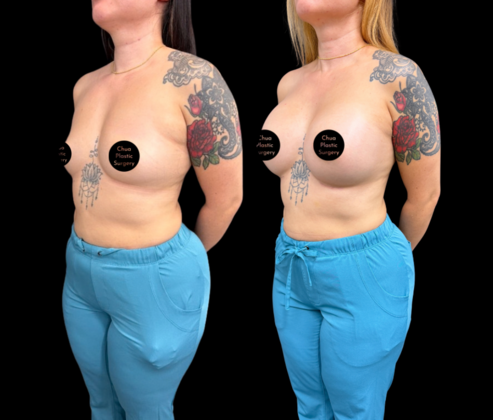 Breast Augmentation Cases