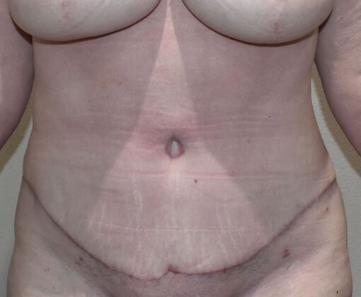 Tummy Tuck (Abdominoplasty): Case 21a - After