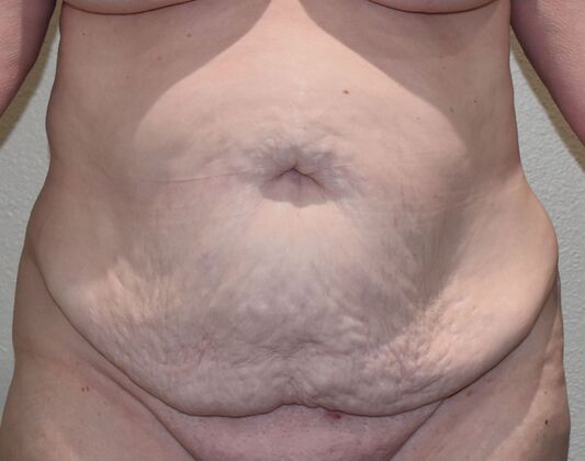 Tummy Tuck (Abdominoplasty): Case 21a - Before