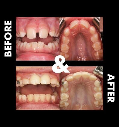 Orthodontics  Valor - Airway Expansion  - Before
