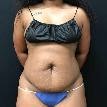 Abdominoplasty: Case 1 - Before