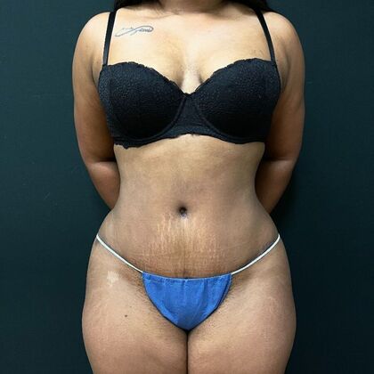 Abdominoplasty: Case 1 - After