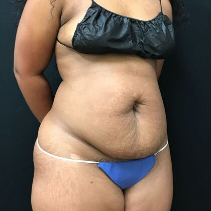 Abdominoplasty: Case 1 - Before