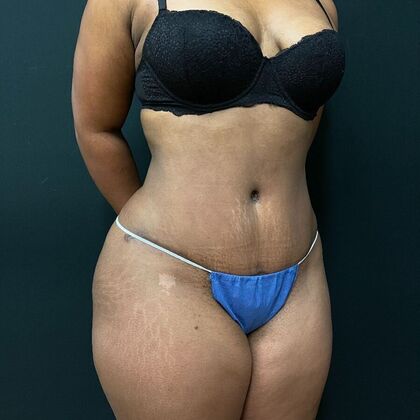 Abdominoplasty: Case 1 - After