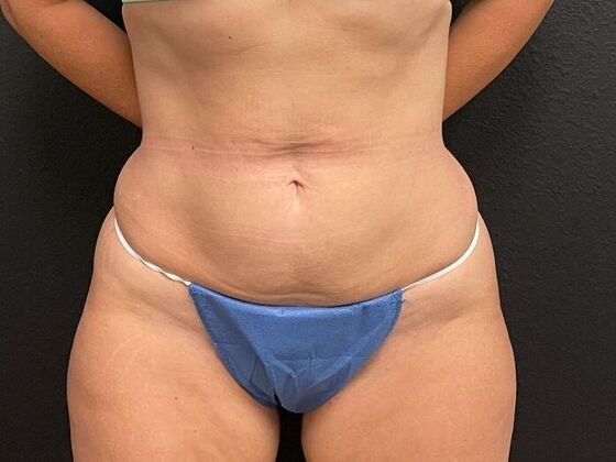 Abdominoplasty Case 2 - Before