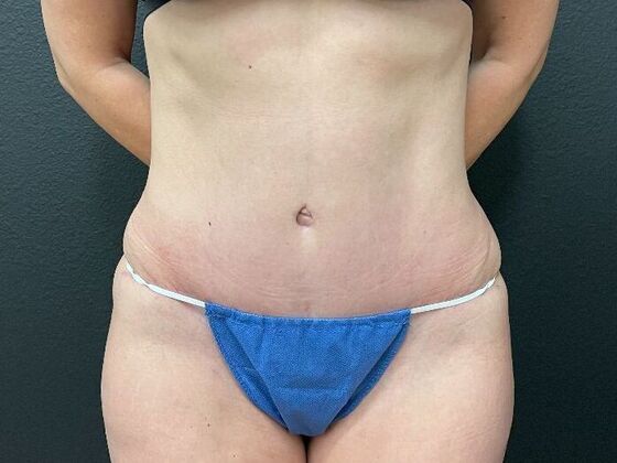 Abdominoplasty Case 2 - After