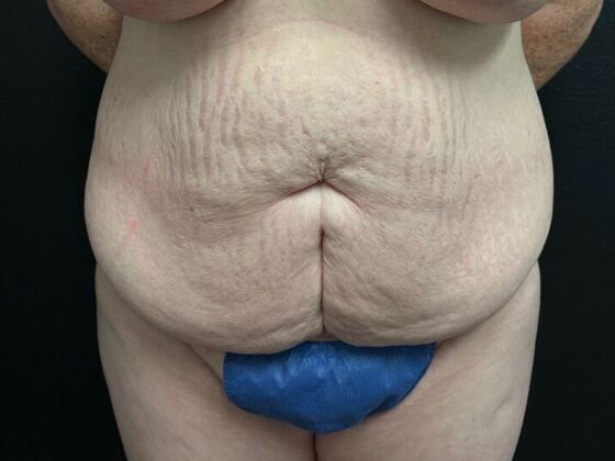 Abdominoplasty Case 3 - Before
