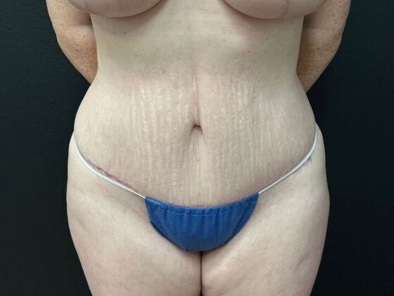 Abdominoplasty Case 3 - After