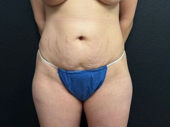 Abdominoplasty: Case 5 - Before