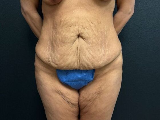 Abdominoplasty: Case 6 - Before