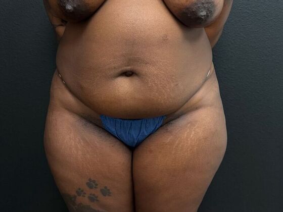 Abdominoplasty: Case 8 - Before