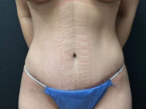 Abdominoplasty: Case 9 - After
