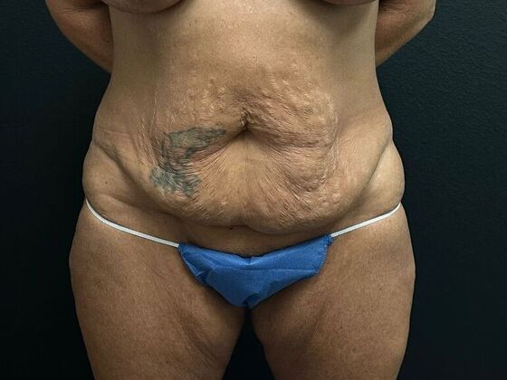 Abdominoplasty: Case 10 - Before