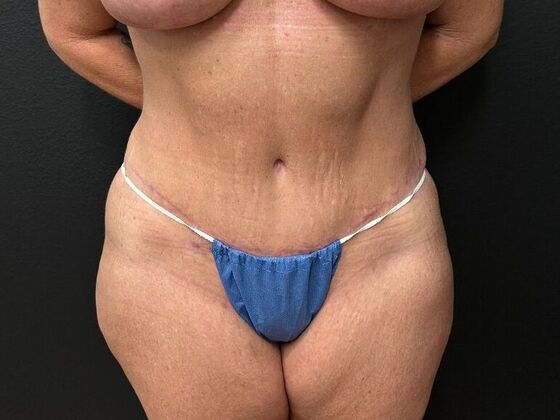 Abdominoplasty: Case 10 - After