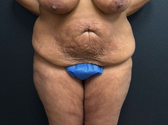 Abdominoplasty: Case 11 - Before