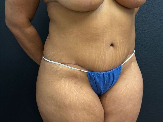 Abdominoplasty: Case 11 - After