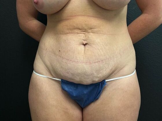 Abdominoplasty Case 12 - Before