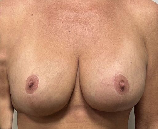 Breast Augmentation w/ Lift: Case 25a - After