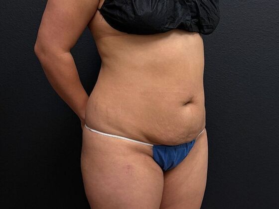 Abdominoplasty: Case 13 - Before