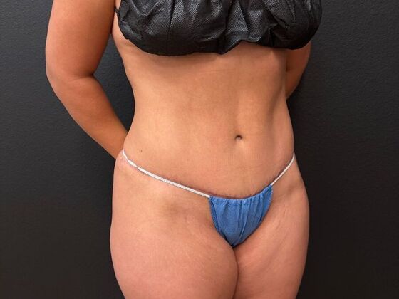 Abdominoplasty: Case 13 - After