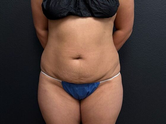Abdominoplasty: Case 13 - Before