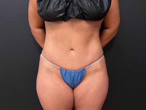 Abdominoplasty: Case 13 - After