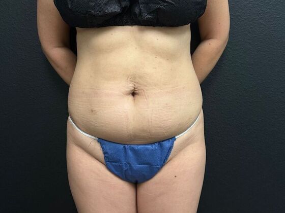 Abdominoplasty: Case 14 - Before