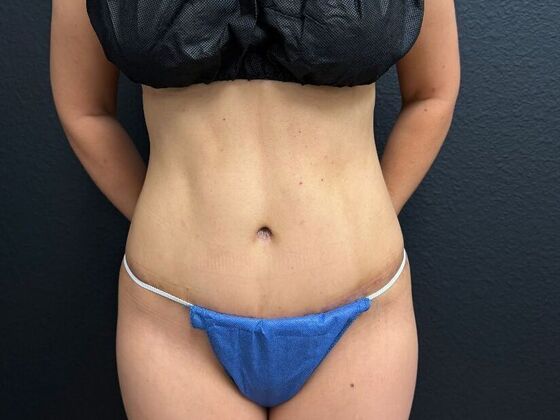 Abdominoplasty: Case 14 - After