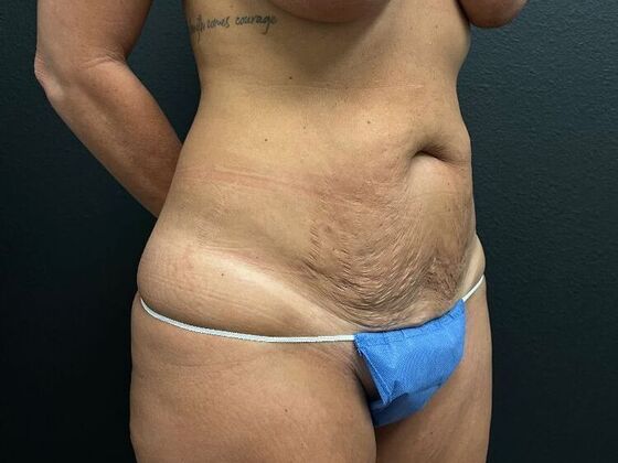 Abdominoplasty: Case 15 - Before
