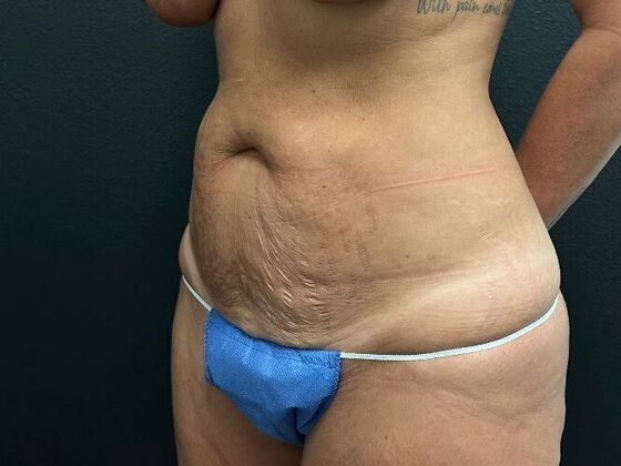 Abdominoplasty: Case 15 - Before