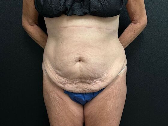 Abdominoplasty: Case 16 - Before
