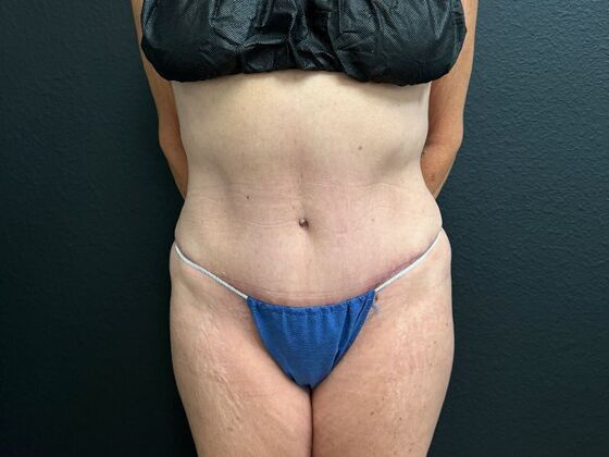 Abdominoplasty: Case 16 - After