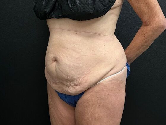 Abdominoplasty Case 16 - Before