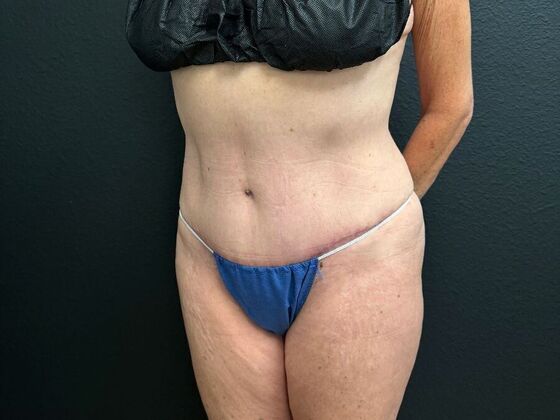 Abdominoplasty Case 16 - After