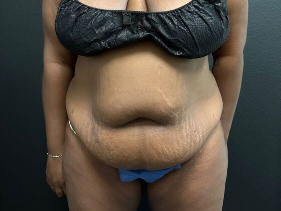 Abdominoplasty: Case 18 - Before