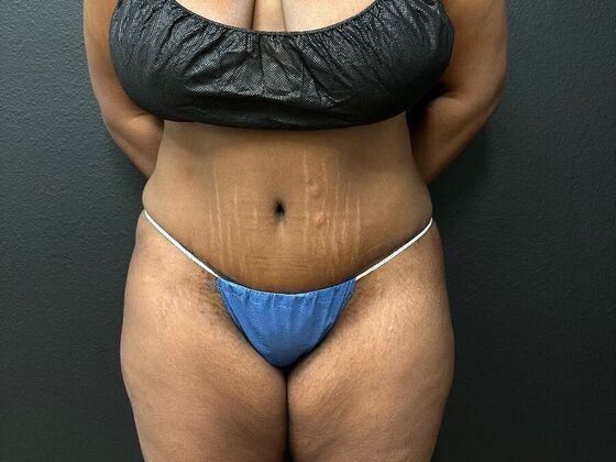 Abdominoplasty: Case 18 - After