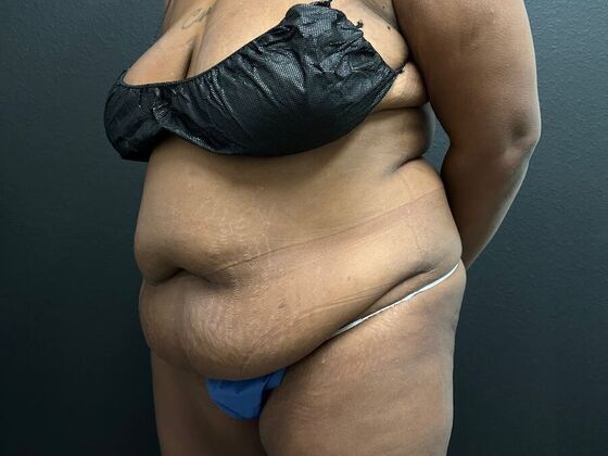Abdominoplasty: Case 18 - Before