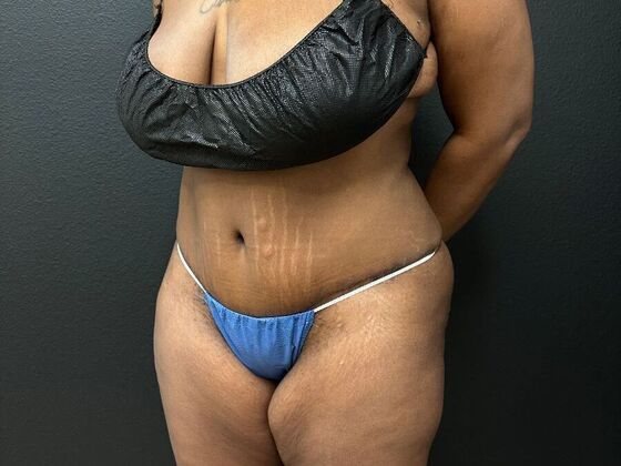 Abdominoplasty: Case 18 - After