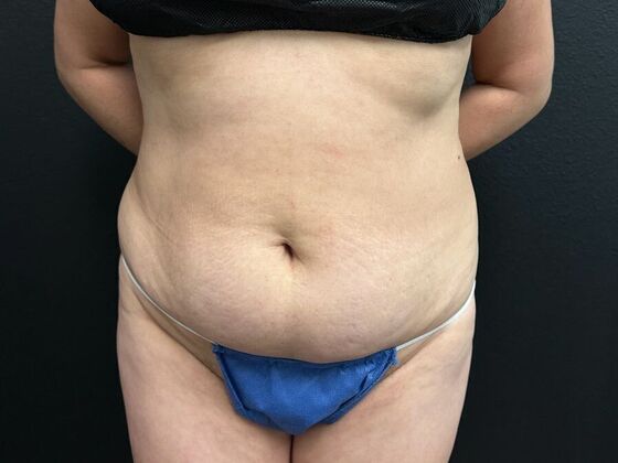 Abdominoplasty Case 19 - Before