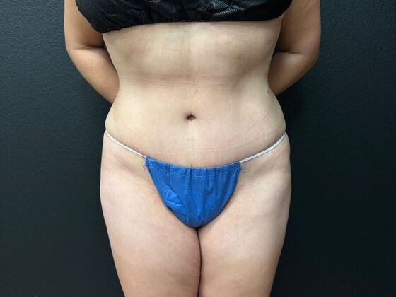 Abdominoplasty Case 19 - After