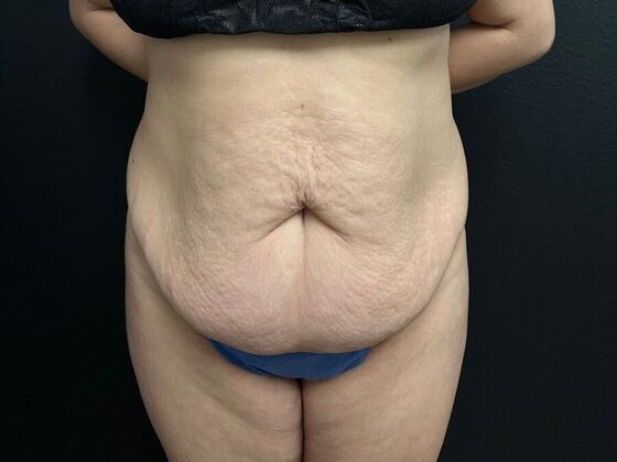 Abdominoplasty Case 20 - Before