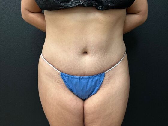 Abdominoplasty Case 20 - After