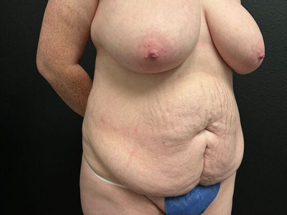 Abdominoplasty: Case 3 - Before