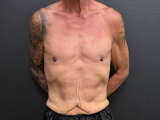 Male Body Contouring: Case 13 Male Abdominoplasty - Before