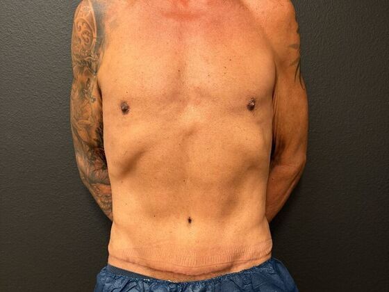 Male Body Contouring: Case 13 Male Abdominoplasty - After