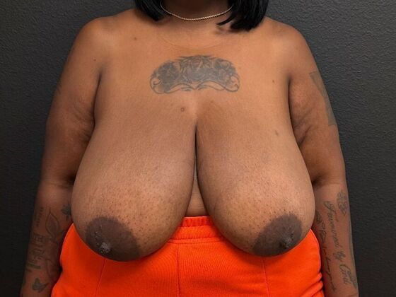 Breast Reduction Case 10 - Before