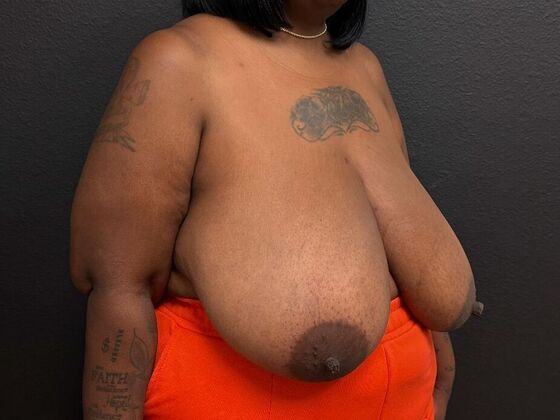 Breast Reduction: Case 10 - Before