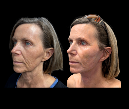 Face & Neck Lifts Cases
