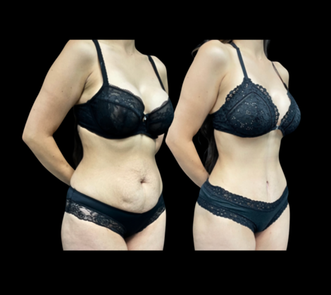 Tummy Tuck Cases